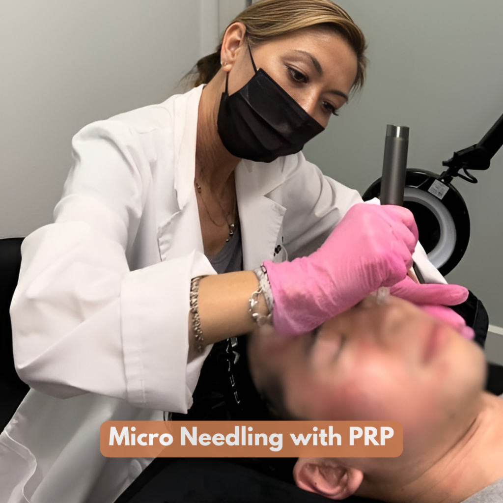 Micro Needling with PRP